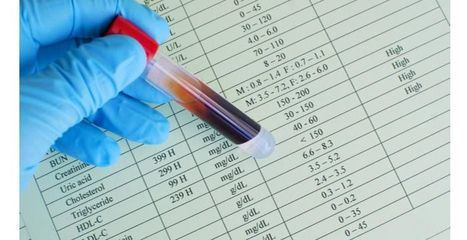 Los niveles altos de triglicéridos causan aneurismas aórticos abdominales, según un estudio