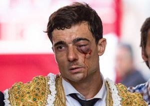 Paco Ureña salva su ojo izquierdo pero se confirma que no recuperará la visión